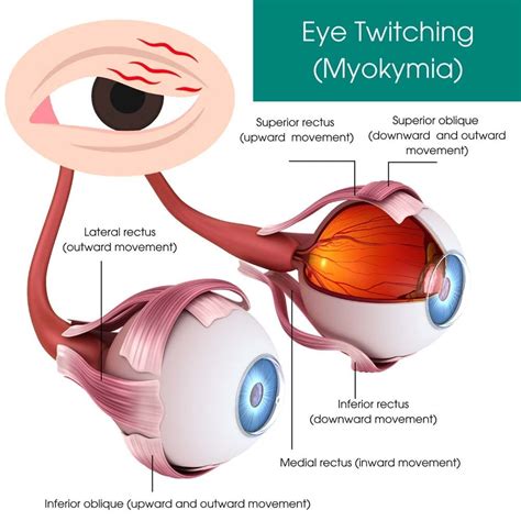 What Causes Eye Twitching