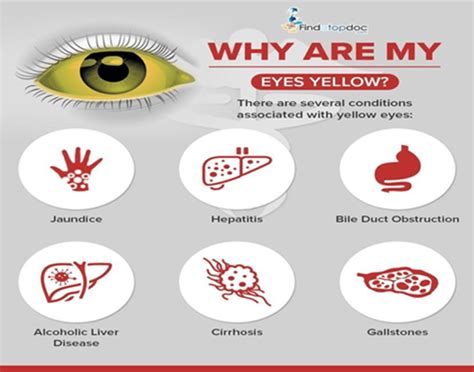 What Causes Eyes To Yellow