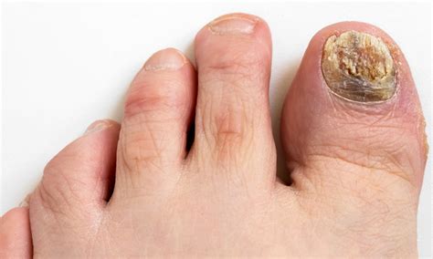 What Causes Fungus On Toenails