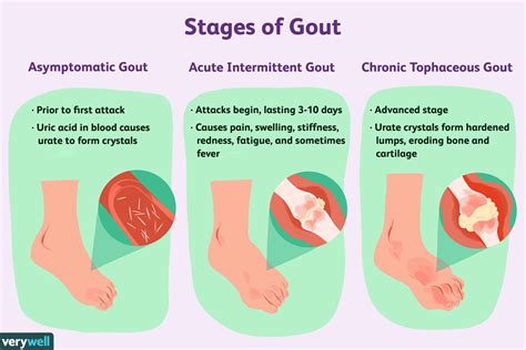 What Causes Gout In The Foot