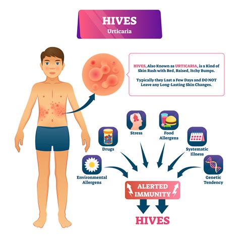 What Causes Hives On Skin