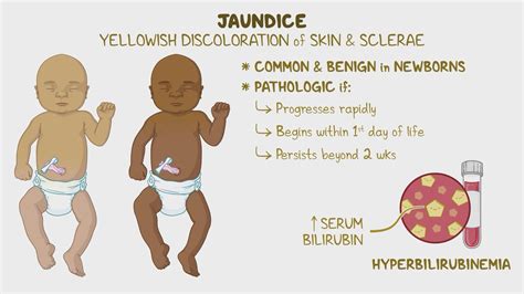 What Causes Jaundice In Babies