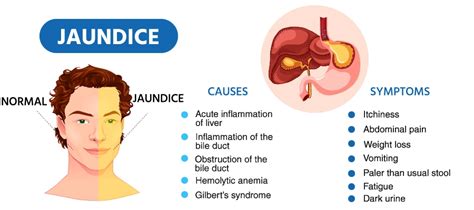 What Causes Jaundice