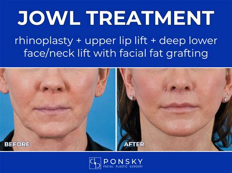 What Causes Jowls