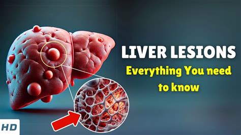 What Causes Liver Lesions
