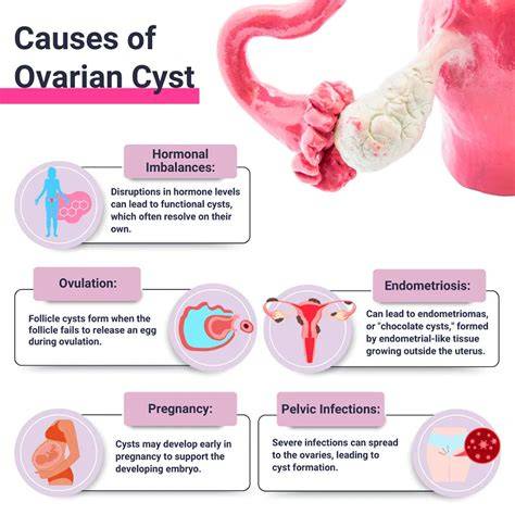 What Causes Ovarian Cyst