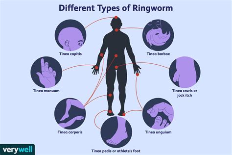 What Causes Ringworm In Humans