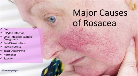 What Causes Rosacea