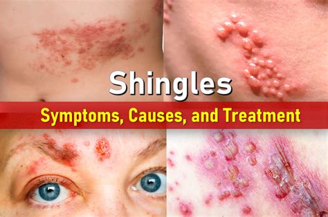 What Causes Shingles