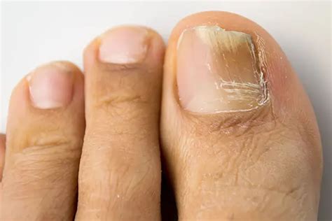 What Causes Toenail Fungus