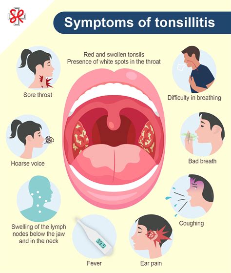 What Causes Tonsillitis