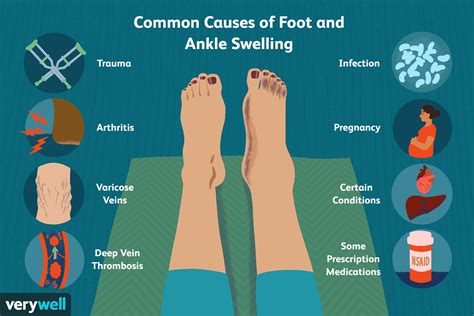 What Causes Your Ankles To Swell