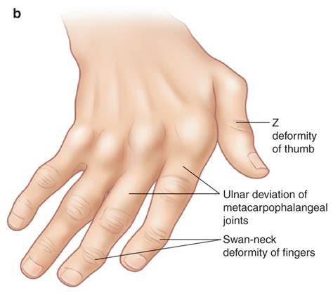 What Causes Z Thumb Deformity