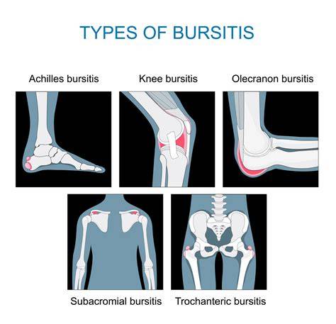 What Cures Bursitis
