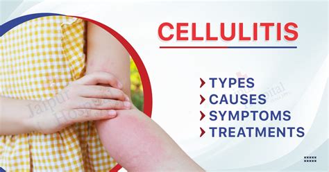 What Cures Cellulitis