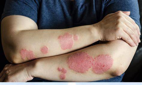 What Cures Contact Dermatitis