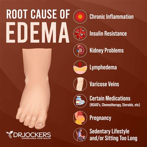 What Cures Edema