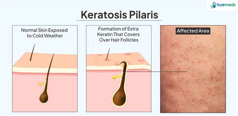 What Cures Keratosis Pilaris