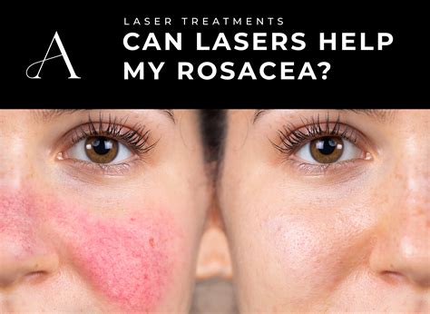 What Cures Rosacea