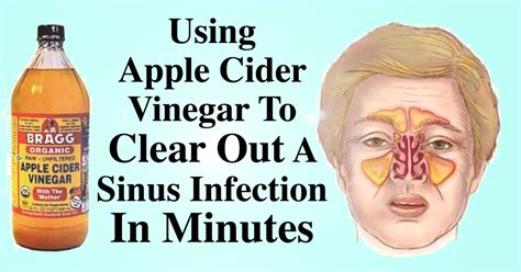 What Cures Sinus Infection