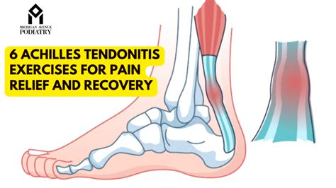 What Cures Tendonitis