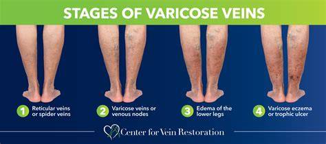 What Cures Varicose Veins