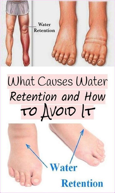 What Cures Water Retention