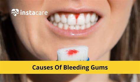What Deficiency Causes Bleeding Gums