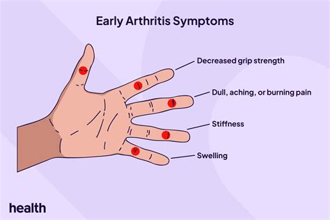 What Does Arthritis Feel Like