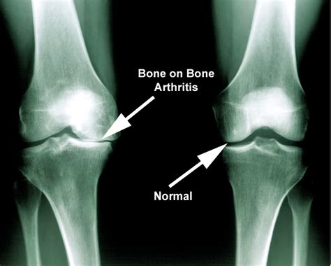 What Does Arthritis Look Like On Xray