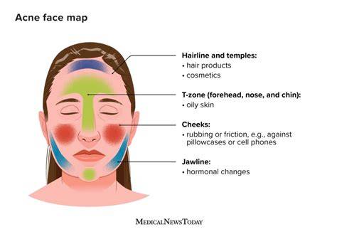 What Does Chin Acne Mean