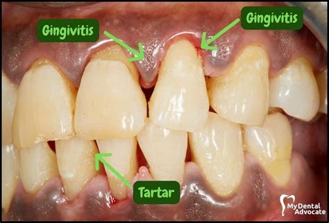 What Does Gingivitis Look Like