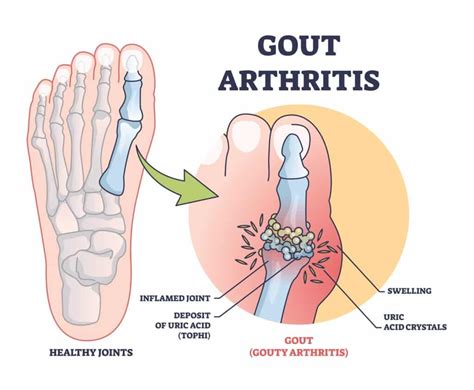 What Does Gout Feel Like And Where