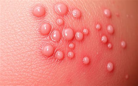 What Does Look Like Herpes Symptoms