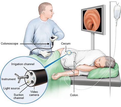 What Happens During A Colonoscopy