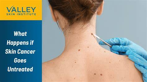 What Happens If Cancer Goes Untreated