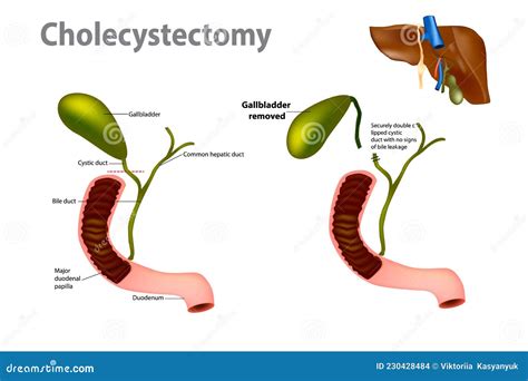 What Happens If Gallbladder Is Removed