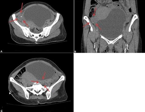 What Happens If Ovaries Are Not Visualized