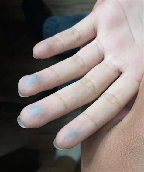 What Happens If U Have Blue Hands