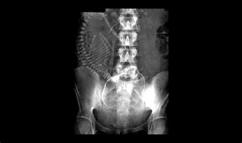 What Happens If X Ray While Pregnant