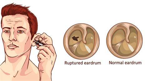 What Happens When Ear Drum Burst