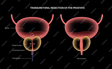 What Happens When Remove Prostate