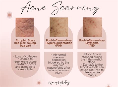 What Helps With Acne Scars