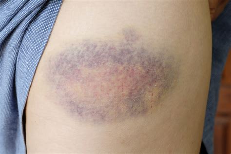 What Helps With Bruising