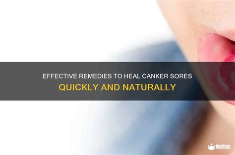 What Helps With Canker Sores