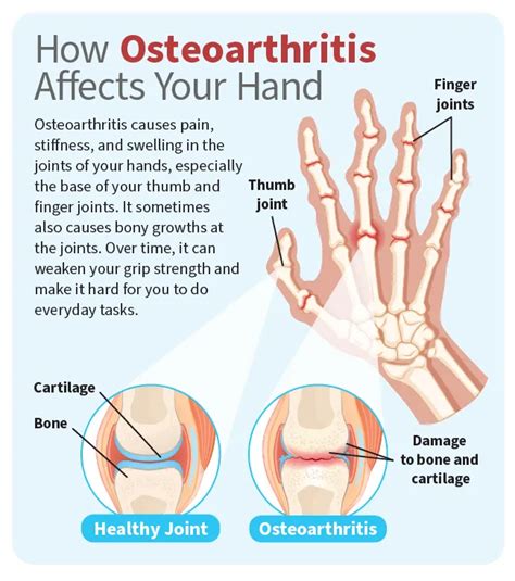 What Helps With Osteoarthritis Pain