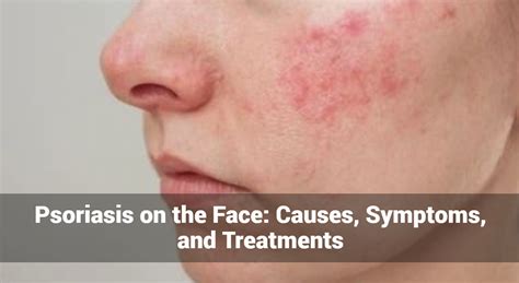 What Helps With Psoriasis
