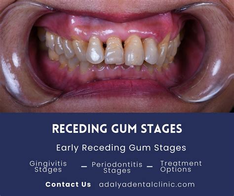 What Helps With Receding Gums