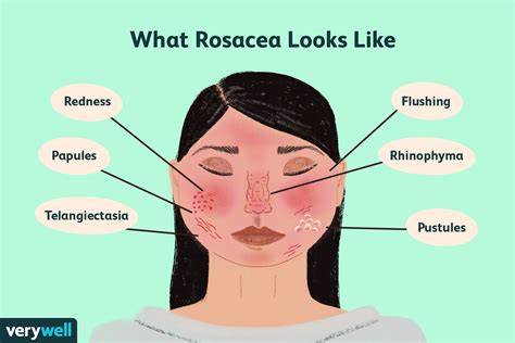 What Helps With Rosacea On Face
