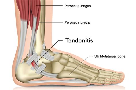 What Helps With Tendonitis